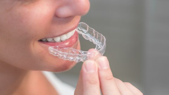 Aligners vs Braces- Know Which One is Ideal for You