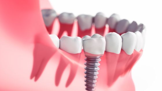 dental implants in Mumbai