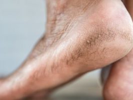 3 Ways to Heal Cracked Heels at Home