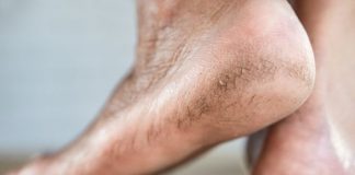 3 Ways to Heal Cracked Heels at Home