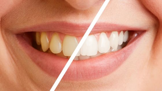 Smile Makeover Can Help You Giving The Best Look You Have Dreamt Off