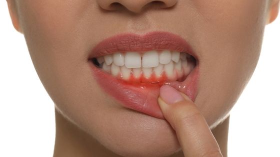What Do You Need To Know About Abscessed Tooth